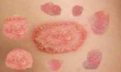 छाला र यौन रोगको उपचार बुटवलमै