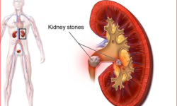 यी हुन् मृगौलाको पत्थरी हटाउने खानेकुराहरु