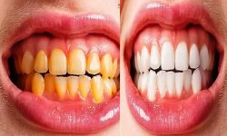 पहेलो दाँत ५ मिनेटमै चम्काउने घरेलु उपाए