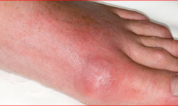 युरिक एसिडबाट बच्ने उपाय