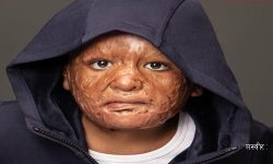 आगोले परिवारका धेरैलाई हरायो, तर आगोलाई जिते बच्चा हिमालले