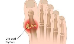 युरिक एसिड कसलाई हुन्छ ? यस्ता छन् बच्ने उपाए ।