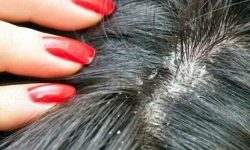 जाडो मौषममा टाउकोमा चाया पर्ने समस्याले हैरान हुनु भएको छ ? यस्ता छन बच्ने उपायहरु