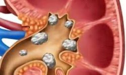 मिर्गौलामा पत्थरी हुँदाका लक्षण र यसको उपचार