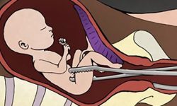 बैतडीमा सुरक्षित गर्भपतन गराउने घटे