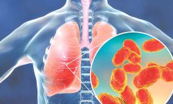 चिसोमा निमोनिया किन हुन्छ ? यसरी गर्नुस रोगथाम