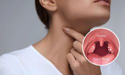 जाडोमा टन्सिल भएर हैरान हुनुहुन्छ ? यस्ता छन घरेलु उपचार