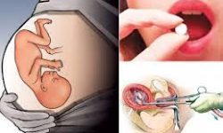 लाञ्छनाको डरले असुरक्षित गर्भपतन बढ्दो