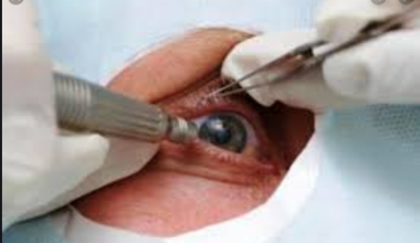 १ सय ६ वर्षिया वृद्धको मोतियाविन्दुको शल्यक्रिया सफल