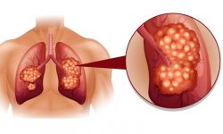 फोक्सोको क्यान्सर हुँदा देखिने लक्षणहरु