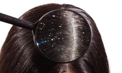 कपालमा चायाँ आएर हैरान हुनुहुन्छ ? यस्ता छन् हटाउने उपाय