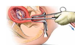 गुल्मीमा गर्भपतन गराउनेको सङ्ख्यामा वृद्धि