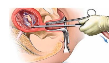 गुल्मीमा गर्भपतन गराउनेको सङ्ख्यामा वृद्धि