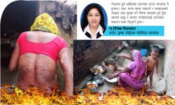 जलनका दुर्घटनामा कमी ल्याउनका लागि आमाहरुलाई सुझाव