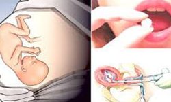 कोरोना प्रभाव : असुरक्षित गर्भपतन बढ्दै