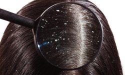 कपालमा चायाँ आएर हैरान हुनुहुन्छ ? छुटकारा पाउन यसो गर्नुहोस्