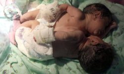 शरीर जोडिएका शिशु जन्मिए