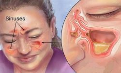 के हो पिनास ? कसरी लाग्छ ? यी हुन उपचार विधि