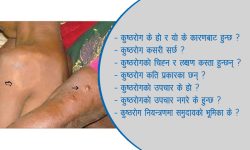 कुष्ठरोग निवारण घोषणा भएको ११ वर्ष बितिसक्दा पनि शुन्यमा झरेन ग्राफ