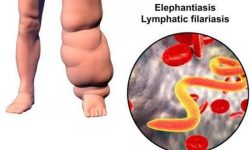 लमजुङमा हात्तीपाइले रोग निवारणमा चुनौती