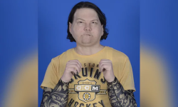 विश्वमै पहिलो पटक अनुहार र दुईवटा हातको सफल प्रत्यारोपण