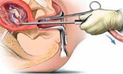 कानुनी सहजताका कारण कर्णालीमा गर्भपतन गराउनेको सङ्ख्या बढ्दो