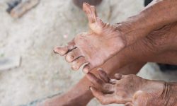 सामाजिक भेदभावले कुष्ठरोग निवारणमा समस्या