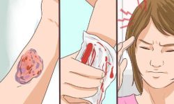 हिमोफिलिया भएका व्यक्तिहरुको वास्तविक तथ्यांक समेट्न माग