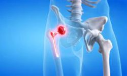 ९७ वर्षकी वृद्धाको अल्का अस्पतालमा सफल शल्यक्रिया