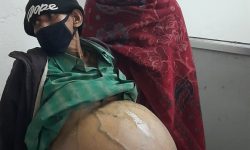 पेटमा पानी भरिने रोगबाट १३ वर्षदेखि ग्रसित श्यामलालको उपचार वीर अस्पतालमा सुरु