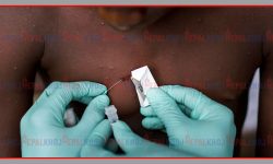 समलिंगी यौन सम्बन्ध राख्ने पुरुषमा मंकिपक्स संक्रमण बढेको पुष्टि !