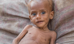 कर्णालीका बालबालिकामा कुपोषणको समस्या बढ्दै, सरकारकाे प्रयास असफल