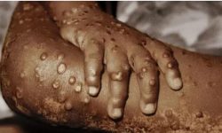 भारतमा मंकीपक्सबाट एक जनाको मृत्यु