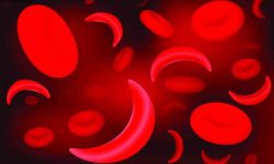 रुपन्देहीमा सिकलसेलका बिरामी बढे