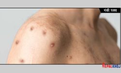 क्यानाडामा मंकीपक्सका संक्रमित ८९० पुगे !