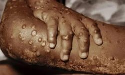 मङ्कीपक्स सङ्क्रमण पुन: देखियो