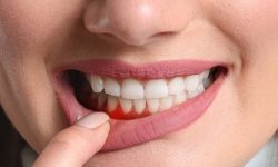 विश्वको ४५ प्रतिशत जनसङ्ख्या मुखको रोगबाट पीडित, ३५० करोडभन्दा बढी प्रभावित