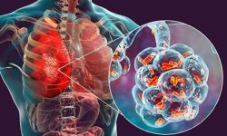 संक्रमणबाट हुने मृत्युको २० प्रतिशत कारण निमोनिया