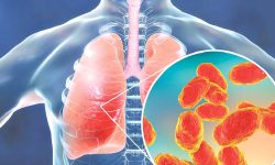 निमोनियाका लक्षण तथा कारकतत्व