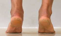 चिसो मौसममा फुटेको कुर्कुच्चाबाट छुटकारा