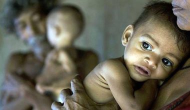 एचआईभी संक्रमितमा कुपोषणको समस्या