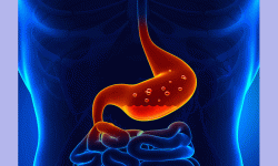 एसिडिटीकाे समस्या छ ? यी हुन् बच्ने उपाय