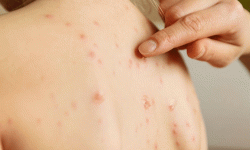 नेपालगञ्जमा एउटै घरका चार बालबालिकामा दादुरा देखियो