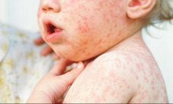 सुनसरीमा तीन जनामा दादुरा पुष्टि