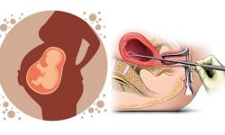 गर्भपतनका कारणले लैङ्गिक असन्तुलन बढ्यो