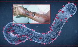 फैलदैँ मारबर्ग भाइरस, के हुन् लक्षण र उपचार ?