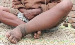 हात्तीपाइले विरुद्धको औषधि थप पाँच दिन खुवाइने