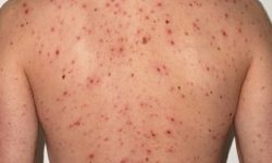 दक्षिण अफ्रिकामा दादुरा संक्रमित ७६६ जना पुगे