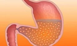 ग्याष्ट्रिक कारक खानेकुराहरू