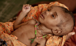 दुर्गमका बालबालिकामा कुपोषणको समस्या